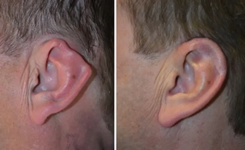 Ear injury — close-up clinical photograph